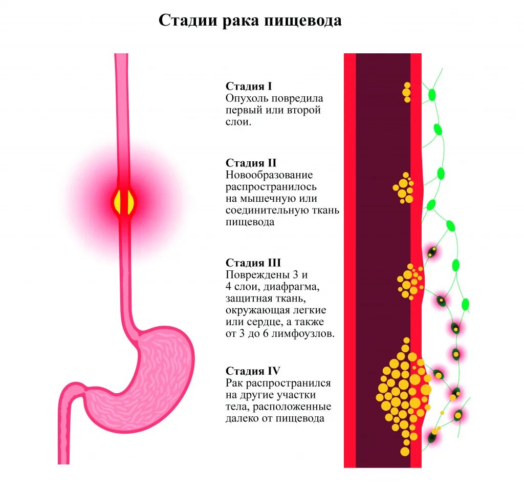 Злокачественные опухоли пищевода. Стадии опухоли пищевода. Opuhol v pischevode.