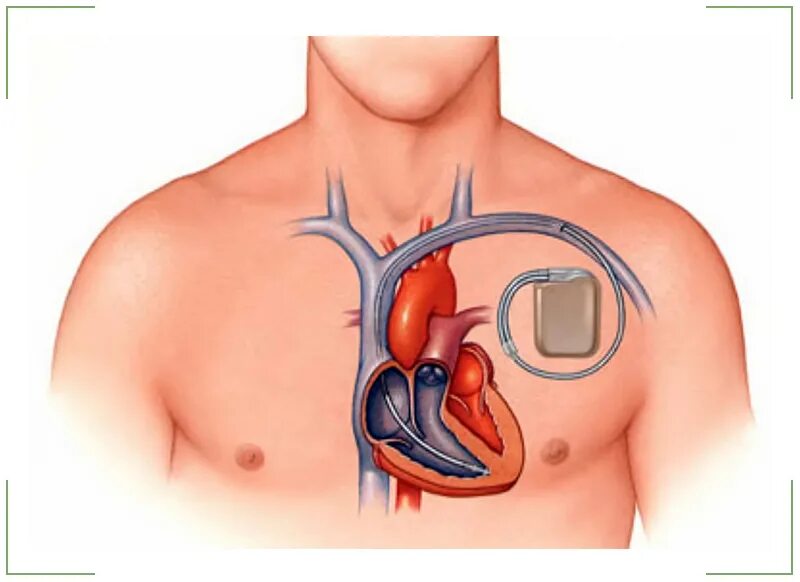 Имплантация кардиостимулятора. Электроды кардиостимулятора. Электрокардиостимулятор имплантируемый.