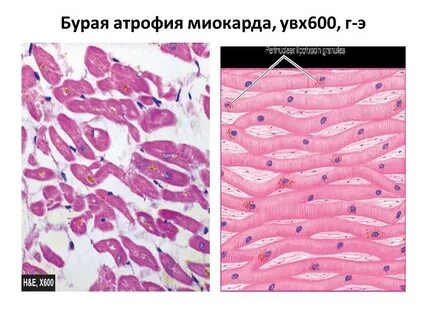 Гипертрофия ткани