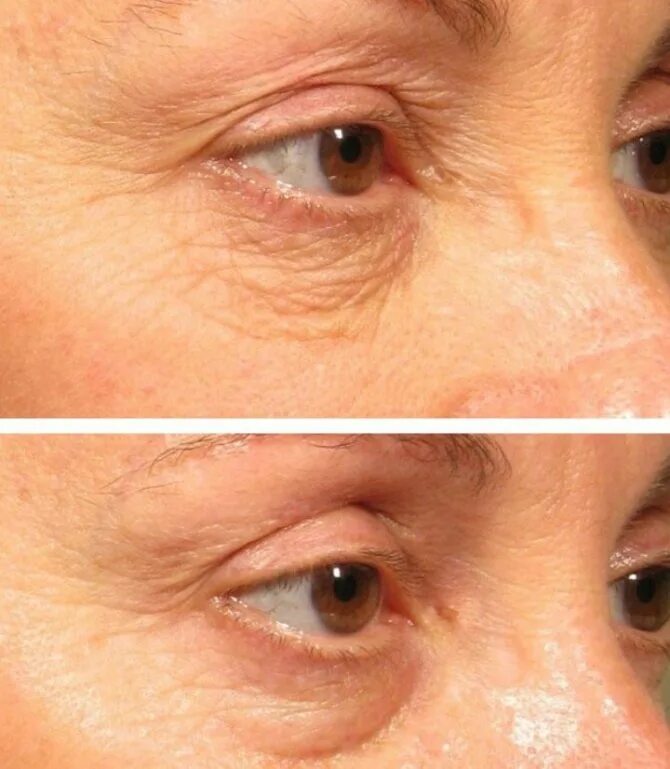 Как подтянуть кожу под глазами. Мимические морщины фото. Лазерная блефаропластика верхних век. Безинъекционная блефаропластика век. Как подтянуть кожу под глазами.