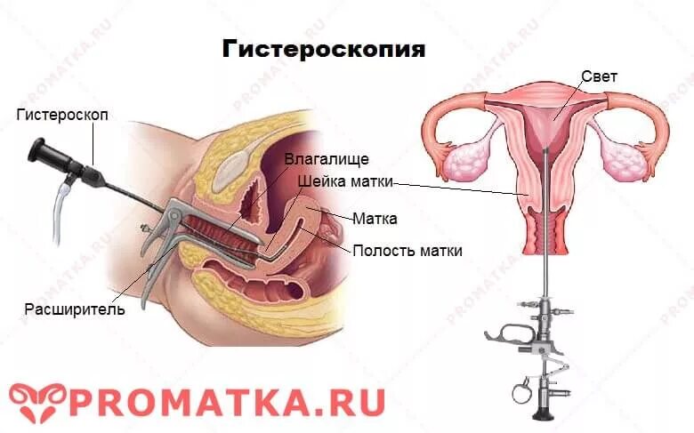 Полип эндометрия гистероскоп. Гистероскопия гинекологические операции. Гистероскопия гиперплазия. Гистероскопия при гиперплазии эндометрия.