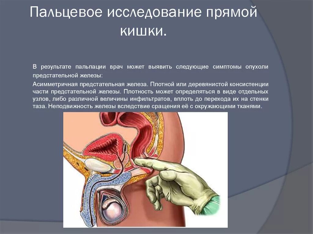 Простаты через прямую кишку