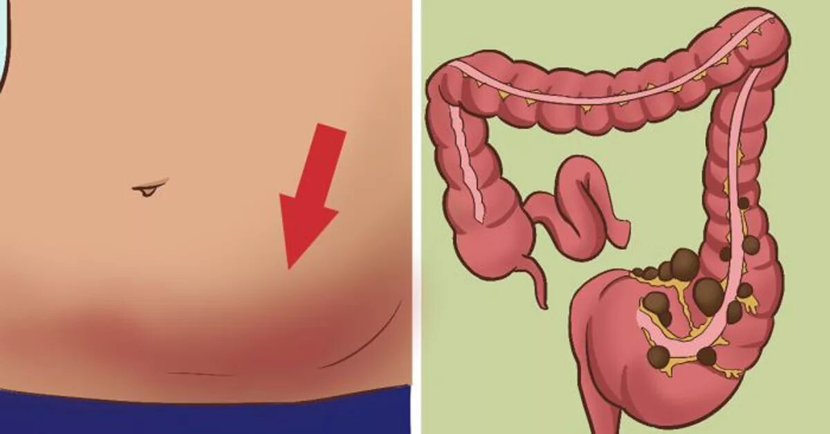 Сильные боли после запора. Раздутая толстая кишка. Кишечник и вздутие живота.