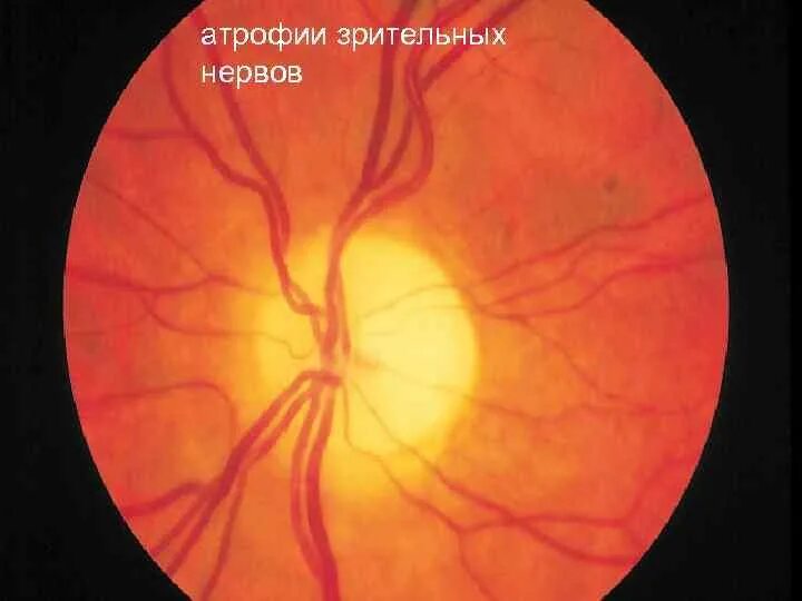 Поражение хиазмы зрительного нерва. Наследственная атрофия зрительного нерва Лебера. Глиома диска зрительного нерва. Аномалии экскавации зрительного нерва.