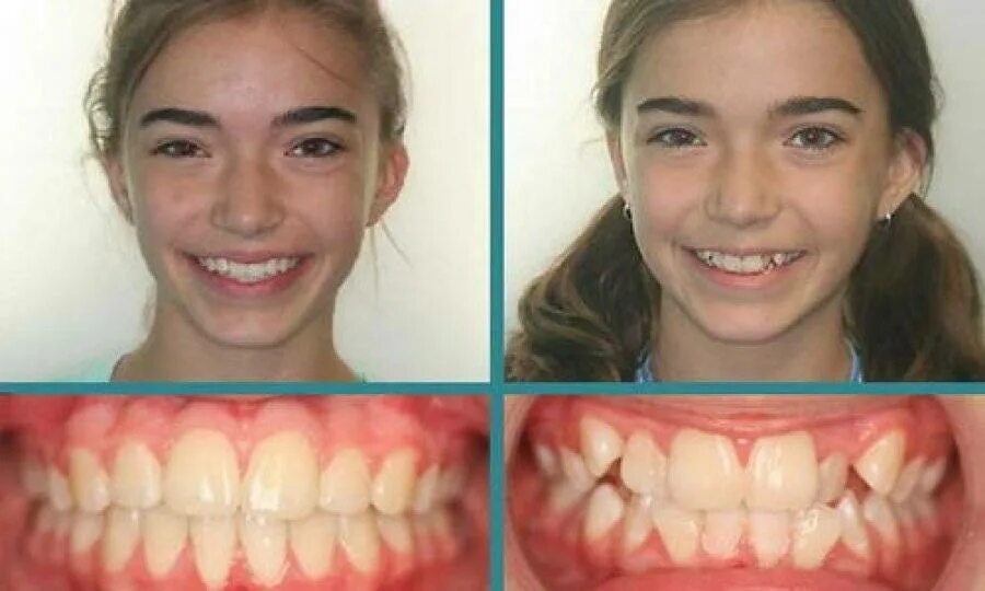 Кривые зубы до и после брекетов. Исправление зубов до и после. Исправление зубов брекетами. Исправление зубов брекетами. Дистальный прикус скученность брекеты.