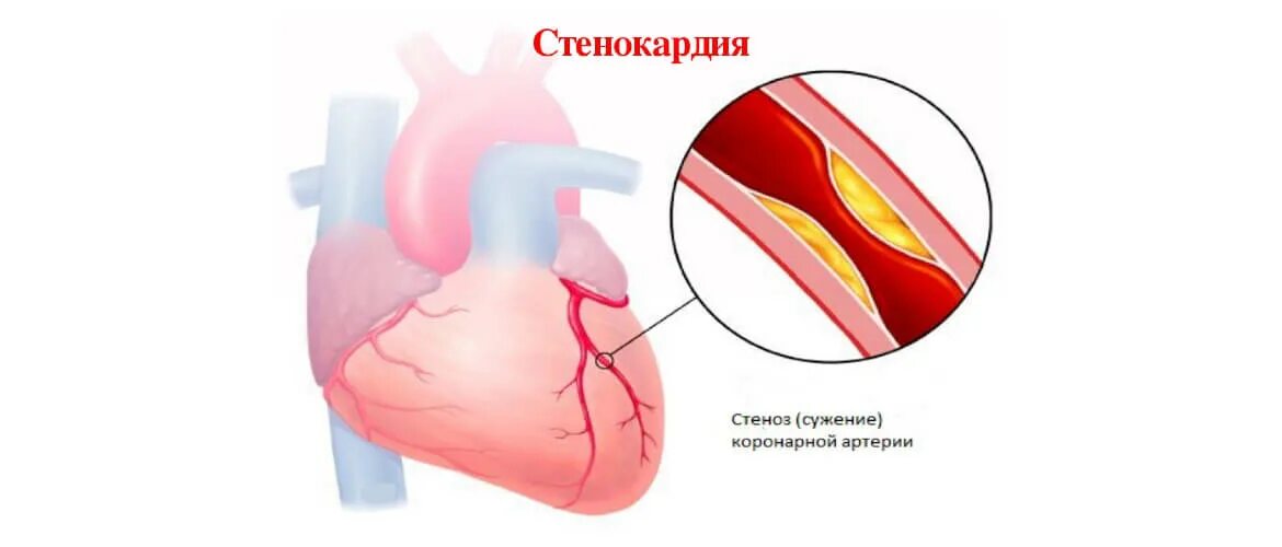 Ишемическая болезнь сердца. Атеросклеротический кардиосклероз. Нестабильная стенокардия фото. Сердце при нестабильная стенокардия. Болезнь тургенева грудная жаба