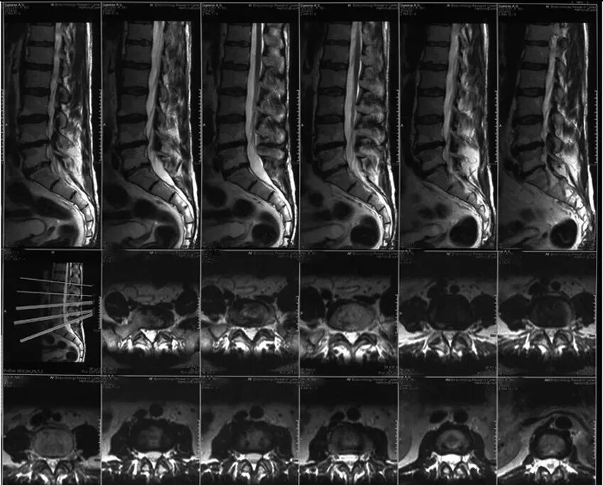 Мрт пояснично крестцового отдела позвоночника цена москва. Мрт пояснично-крестцового отдела позвоночника. Протрузии в поясничном отделе позвоночника на кт. Снимки мрт пояснично-крестцового отдела позвоночника. Кт пояснично-крестцового отдела позвоночника норма.