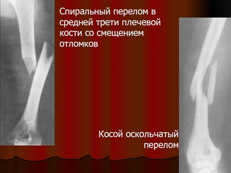 Оскольчатый перелом без смещения. Перелом средней трети диафиза плечевой кости. винтообразный перелом плечевой кости. перелом нижней трети диафиза плечевой кости. субкапитальный перелом плечевой кости рентген.