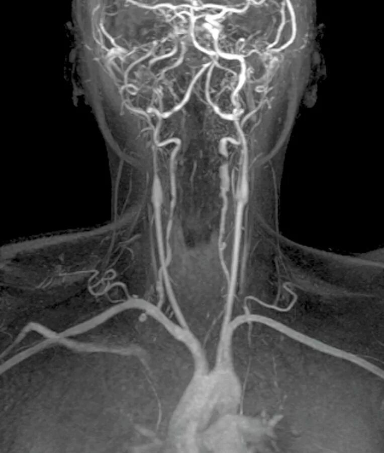 давид artery. кт ангиография артерий шеи. верхняя артерия щитовидной железы. патологии сосудов шеи. патологии сосудов шеи.