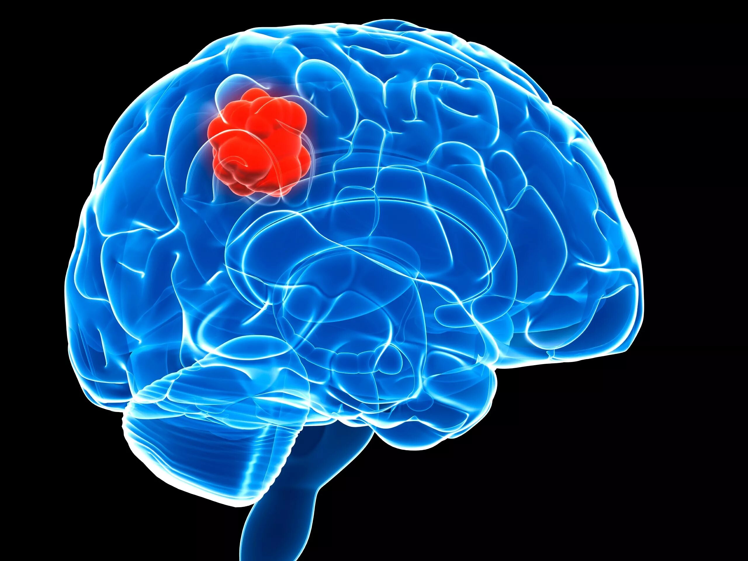 Brain 226. Злокачественное новообразование головного мозга. Опухоль мозга глиобластома. Опкхолльлголовного мозга. Доброкачественная опухоль мозга.