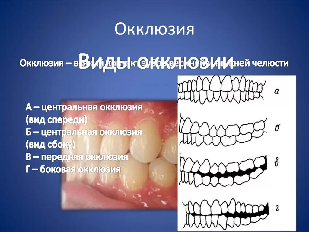 Центральная окклюзия. Окклюзия это в стоматологии. Центральная окклюзия это в стоматологии. Артикуляция зубов