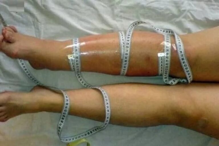 жидкость через кожу ног