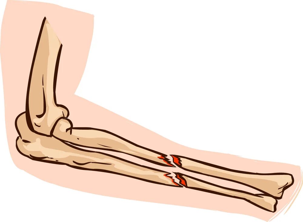 Break a bone. Открытый перелом кости. Закрытый перелом рисунок.