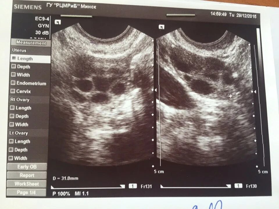 Можно делать узи перед месячными. Снимок УЗИ поликистоза. Снимок УЗИ перед месячными.