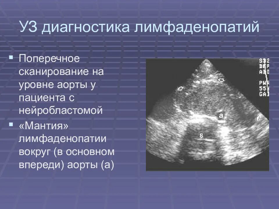 Увеличение лимфоузлов селезенки. УЗИ лимфоузлов брюшной полости. Забрюшинные лимфоузлы на УЗИ. Лимфоузлы брюшной полости на УЗИ.