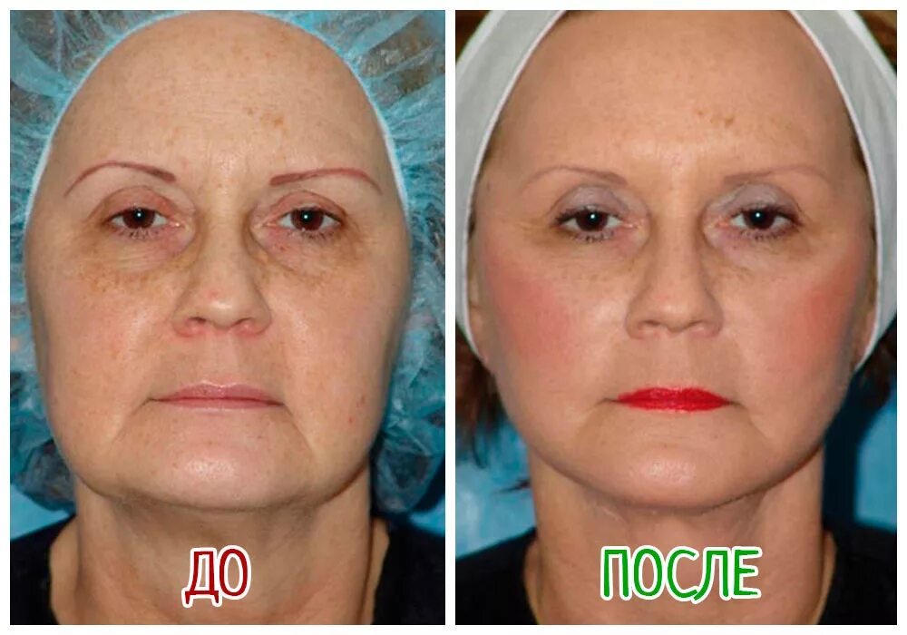 Подтяжка лица до и после. Фейслифтинг пластическая операция. Круговая подтяжка лица до и после. Круговая поддяжкалица.