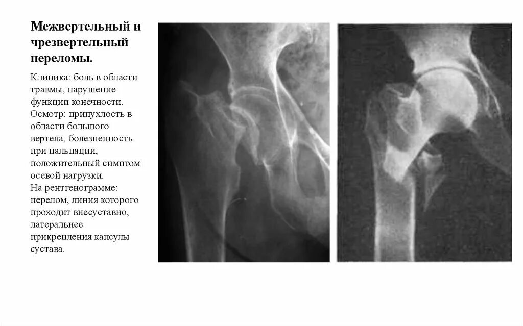 описание перелома бедра. описание перелома бедра. перелом шейки бедренной кости рентген описание. закрытый оскольчатый чрезвертельный перелом бедра. чрезвертельный оскольчатый перелом левой бедренной кости.