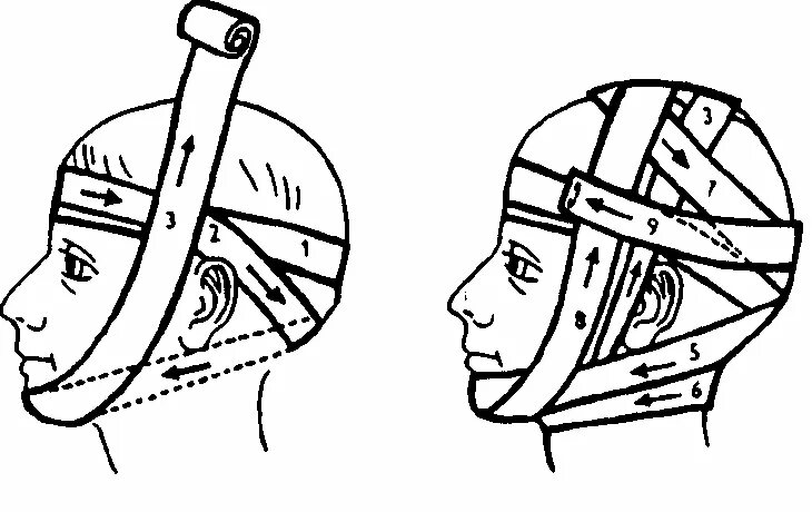 Как перевязывать голову. Круговая бинтовая теменно-подбородочная повязка. Повязка уздечка техника наложения. Перевязка чепец и уздечка. Теменно подбородочная повязка Гиппократа.
