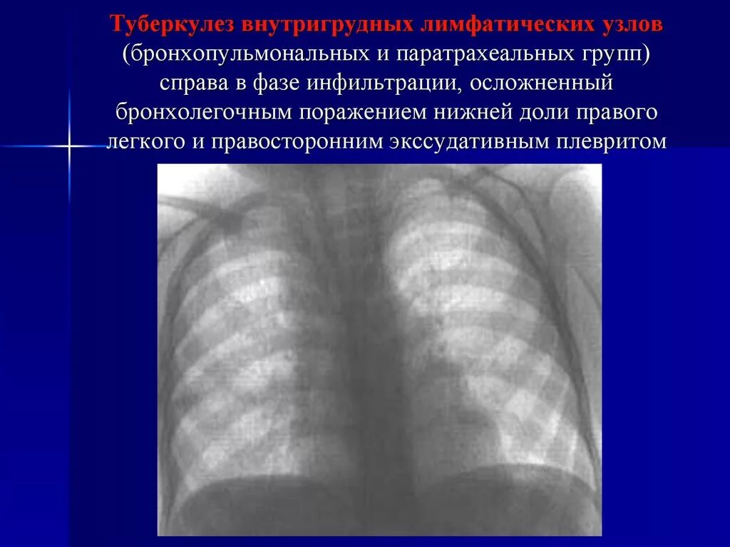 Туберкулез лимфатических узлов рентгенограмма. Туберкулез внутригрудных лимфатических узлов в фазе инфильтрации. Туберкулез внутригрудных лимфатических узлов справа. Увеличение внутригрудных лимфоузлов рентген. Увеличение лимфоузлов в легких причины