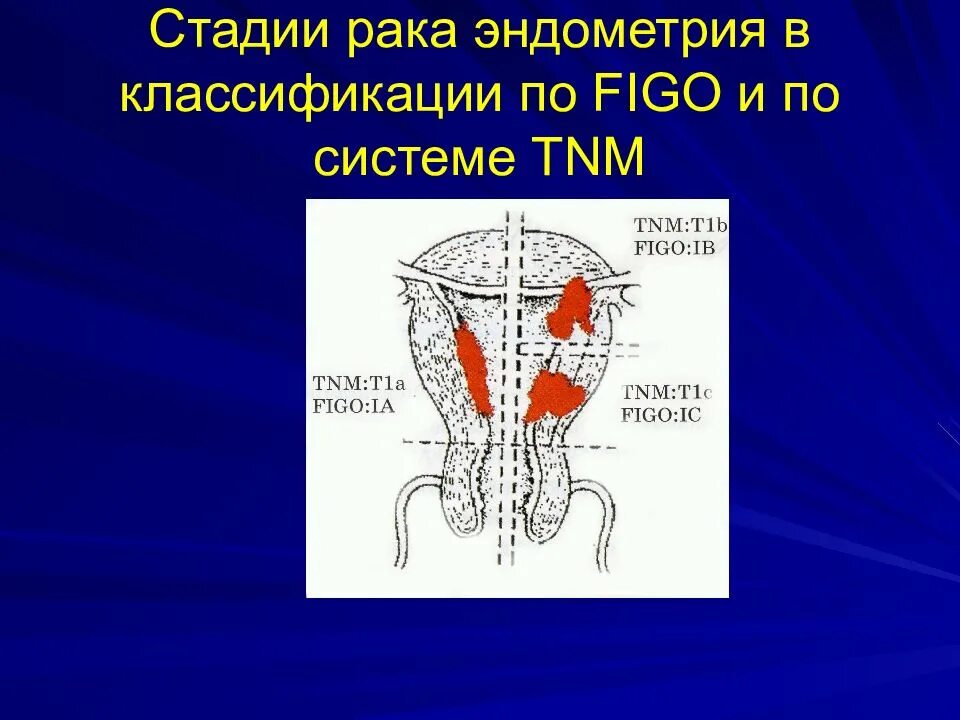 Группа раке матки. Классификация TNM опухолей матки. Классификация стадий эндометрия. Эндометриальная карцинома стадии.