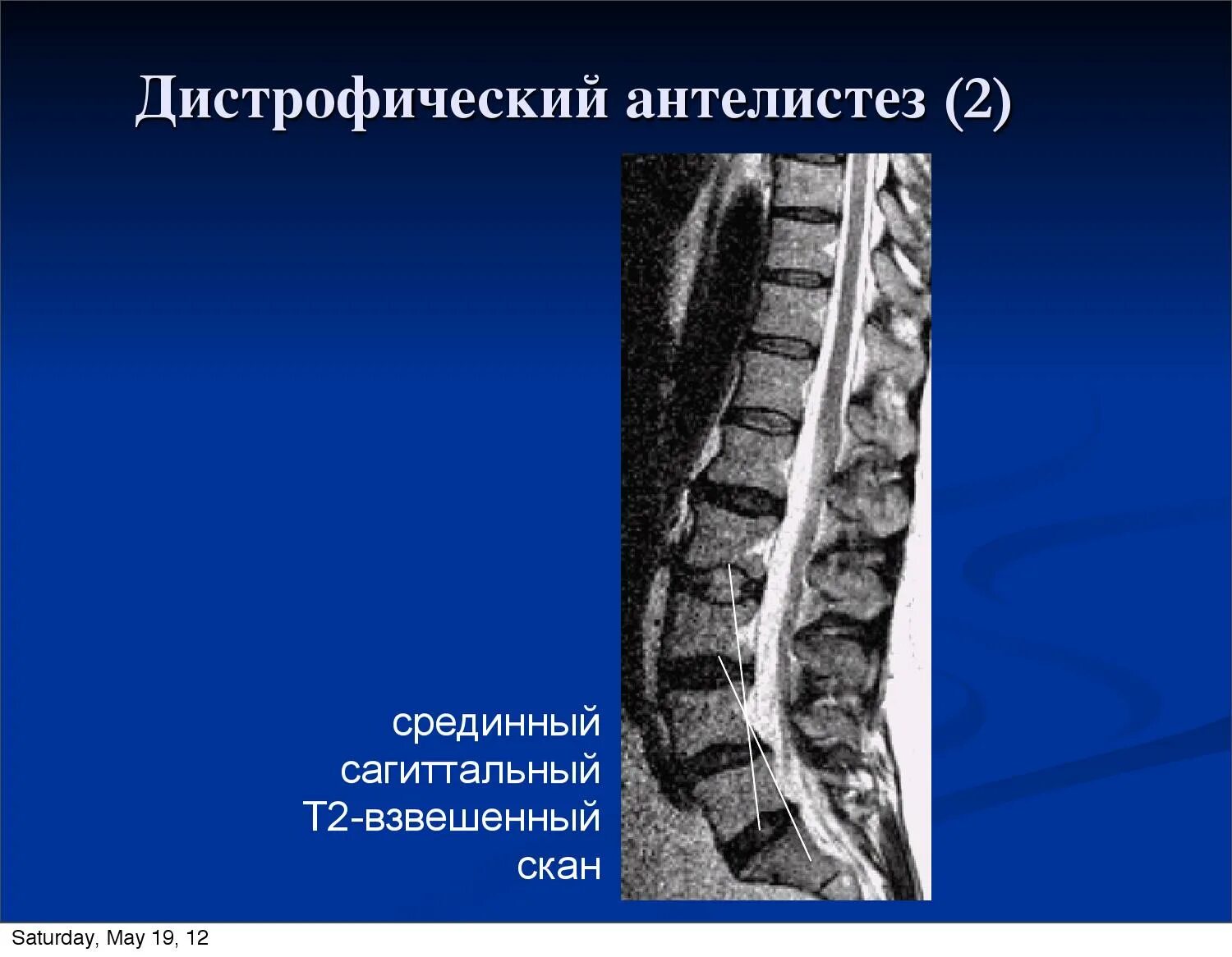 Антелистез 1 степени