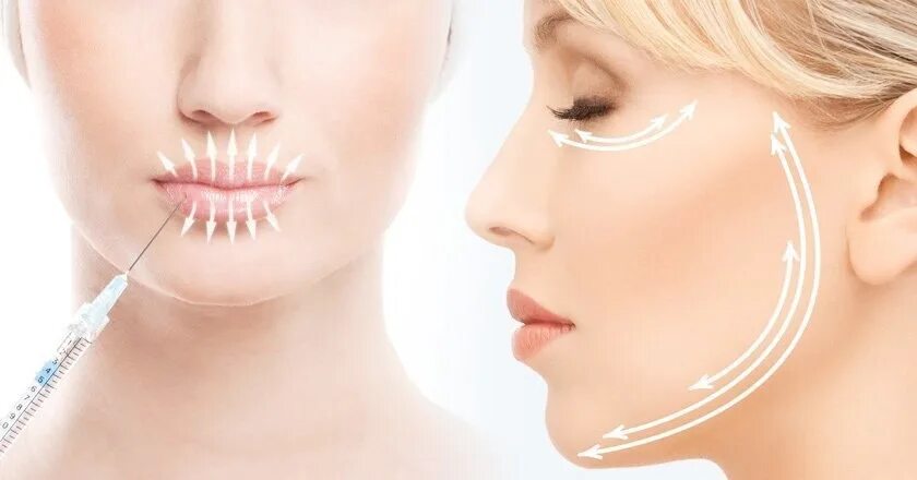 Контурная пластика лица skinlift. Контурная пластика филлерами. Контурная пластика лица филлерами. Внутрикожная контурная пластика. Филлеры на основе гиалуроновой кислоты.