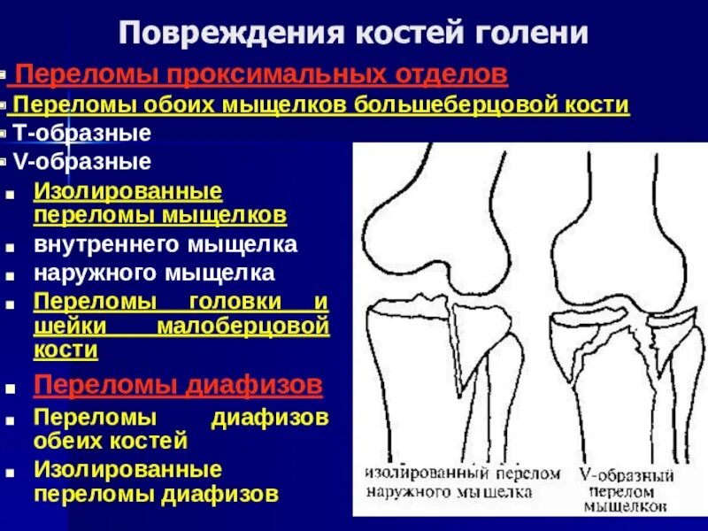 Лечение мыщелка. Переломы мыщелков большеберцовой кости классификация. Перелом проксимального метафиза большеберцовой кости. Перелом проксимального отдела большеберцовой кости. Вколоченный перелом малоберцовой кости.