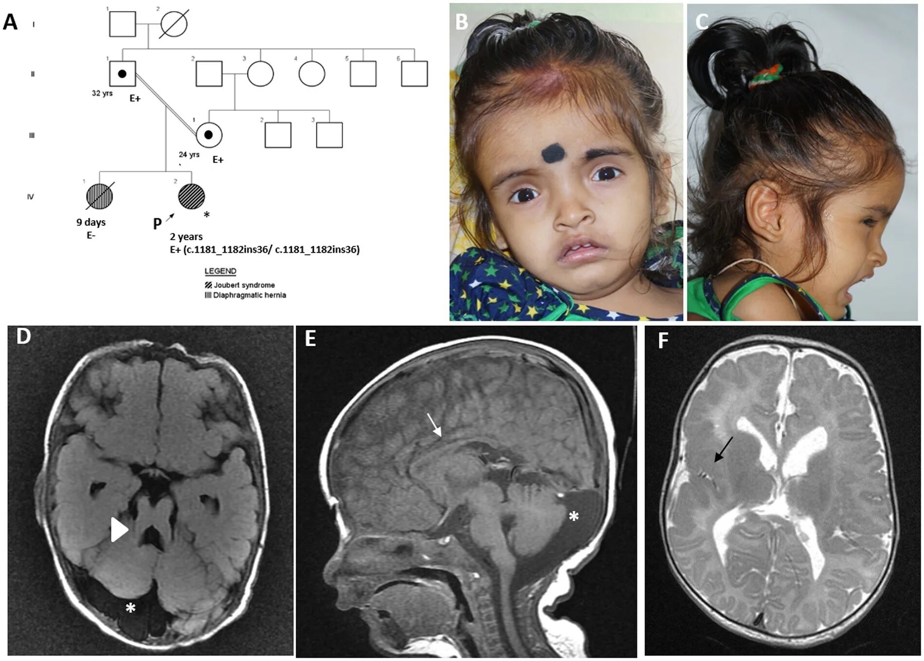 Гипоплазия червя. Joubert Syndrome синдром Жубера. Мозжечок синдром Жубера.