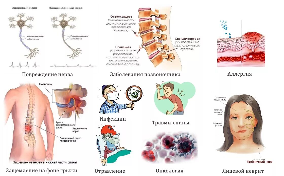 Причины возникновения заболеваний периферической нервной системы. Патогенез поражения периферический нервной системы. Основные симптомы заболеваний ПНС.. Заболевания позвоночника и периферической нервной системы.