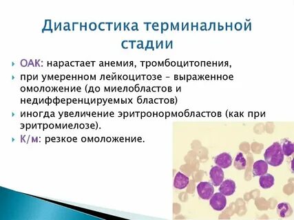 Анемия тромбоцитопения лейкоцитоз