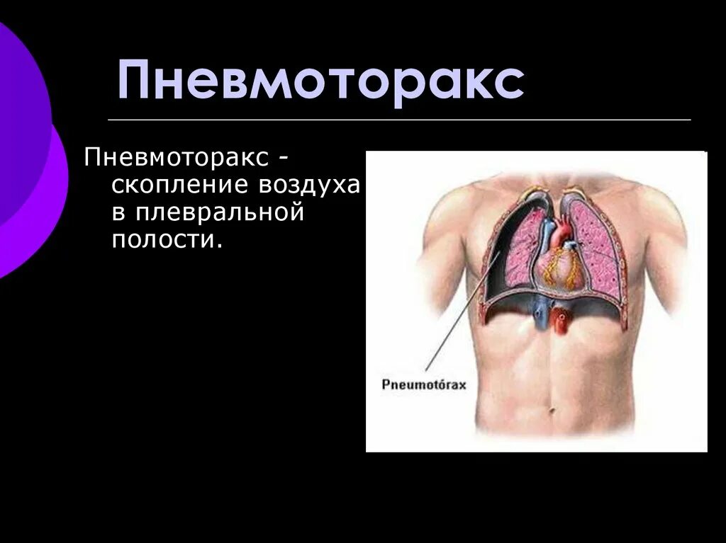 Лечение плевральной полости. Осумкованный паракостальный пневмоторакс. Баротравматический пневмоторакс. Травматический пневмоторакс рентген. 1. Спонтанный пневмоторакс.