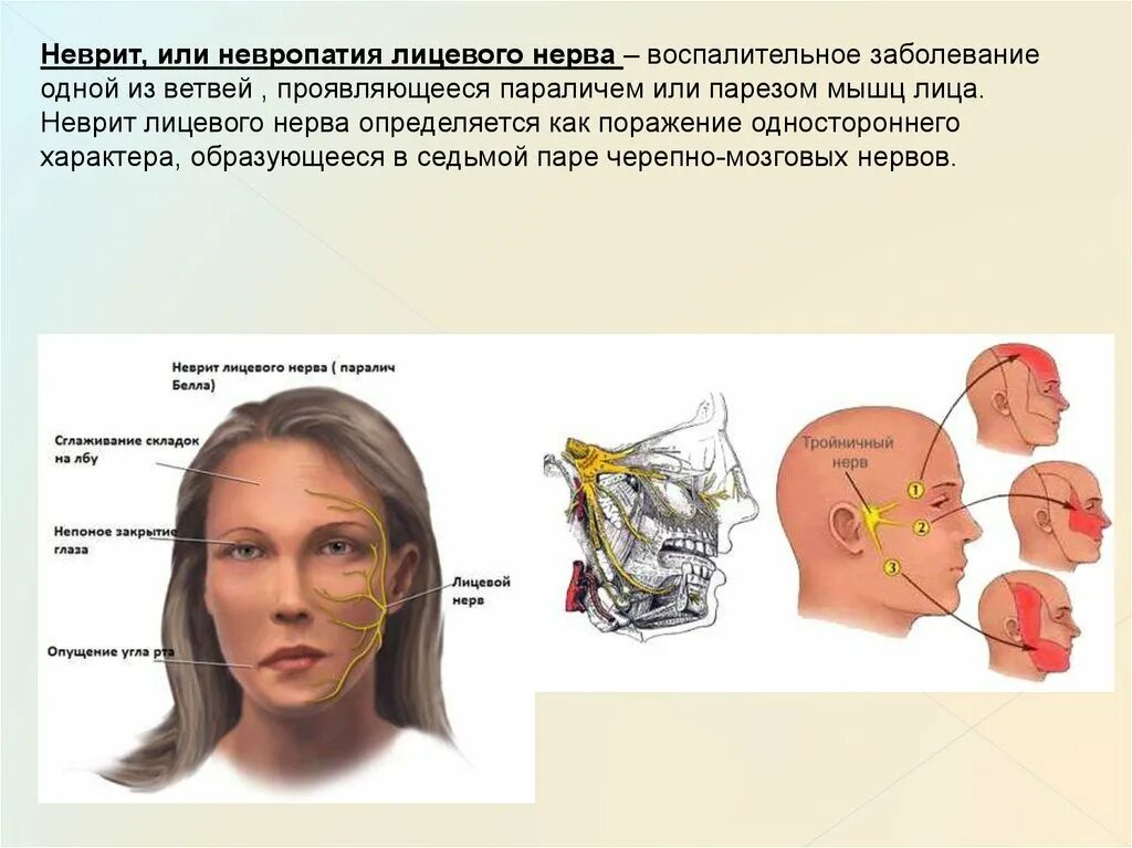 Невропатия полового. Неврит лицевого нерва. Упражнения при неврите тройничного нерва.