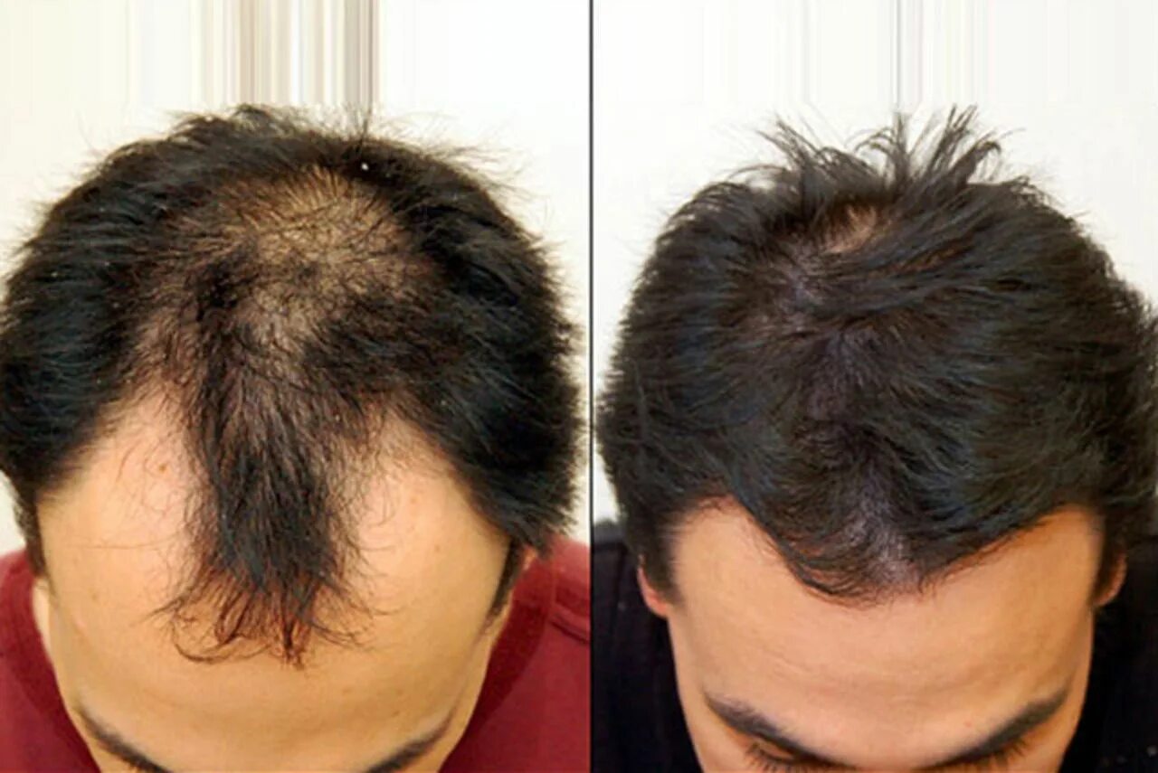 Выпадение волос до и после. Пересадка волос фото до и после. Hairmed для волос. Пересадка волос выпадают волосы