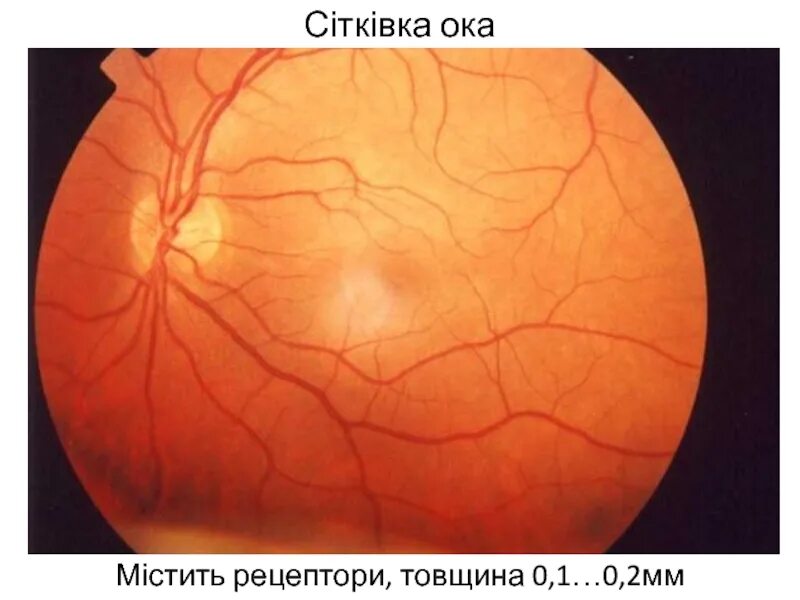 Рефракция в миопическом глазу. Макулярный разрыв сетчатки глаза. Бионические линзы суперзрение. Сетчатка глаза офтальмоскопия. Миопия рефракция.