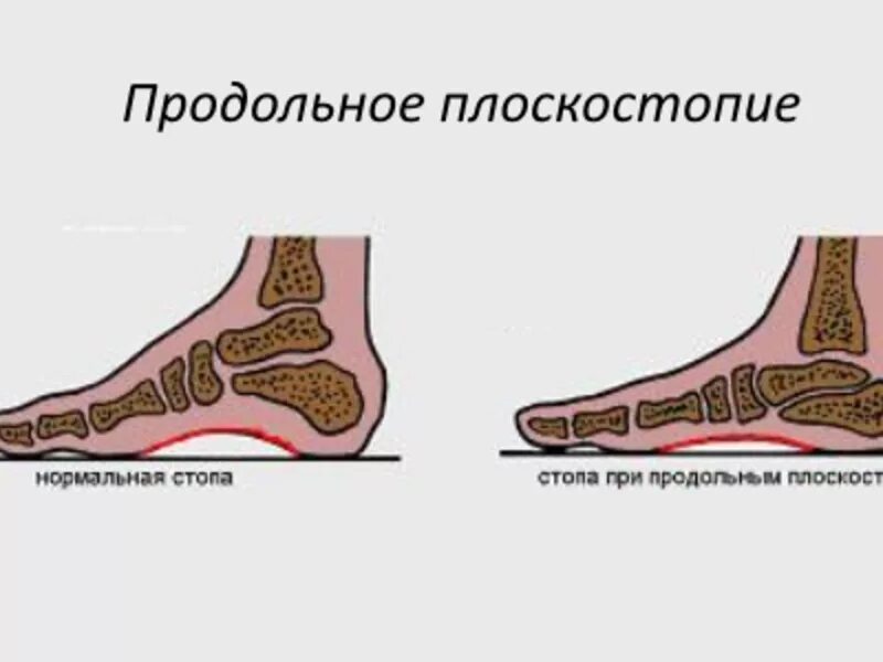 Поперечное 1 степени. Продольное и поперечное плоскостопие 1 и 2 степени. Продольное поперечное и комбинированное плоскостопие. Поперечное и продольное плоскостопие стопы. Двустороннее продольно поперечное плоскостопие.