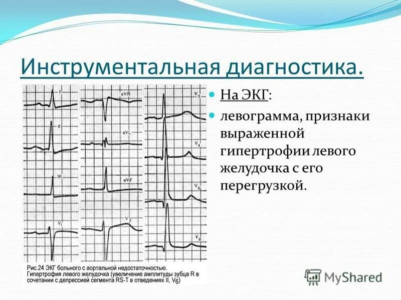 Гипертрофия правого желудочка на экг. Гипертрофия правого желудочка rsr типа. Концентрическая и эксцентрическая гипертрофия левого желудочка. Экг при гипертрофии правого желудочка s тип. Тип гипертрофии левого желудочка.