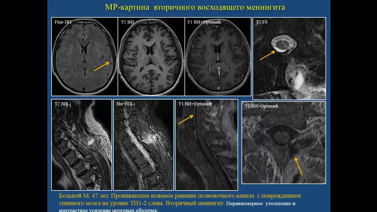 Гнойный мозг. Воспаление мозговых оболочек мрт. Менингит головного мозга на кт.