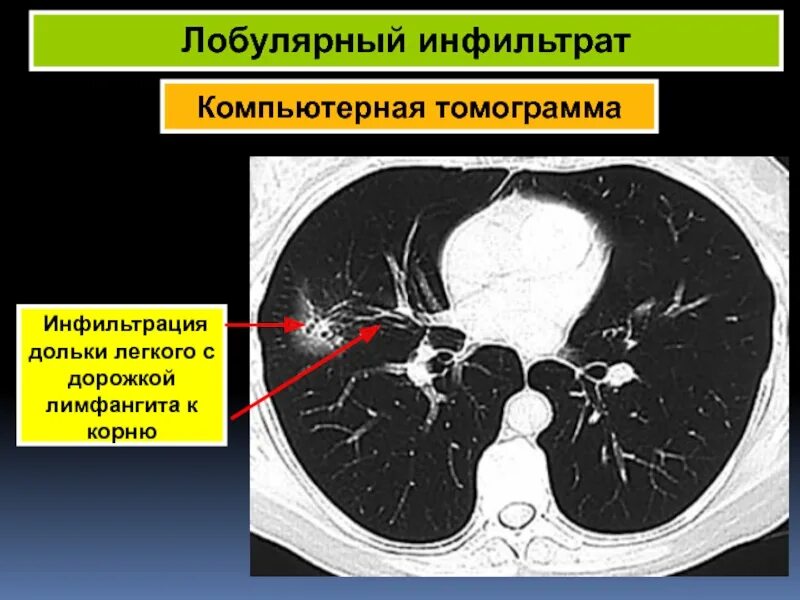 Солидный узел в легких. Карциноматозный лимфангит кт. Бронхолобулярный инфильтрат кт. Инфильтрация на кт легких.