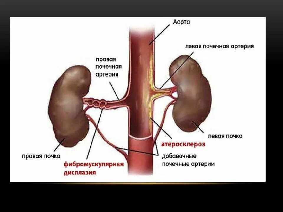 Атеросклероз артерий почек почечная форма. Фиброзно-мышечная дисплазия почечных артерий. Фибромускулярная дисплазия почечной артерии. Солитарная почечная артери. Функция почечной артерии