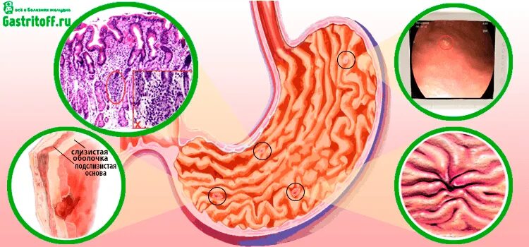 Очаговый атрофический гастрит. Эрозивно геморрагический гастрит. Эрозия язва гастрит желудка. Поверхностный и атрофический гастрит. Признаки атрофией слизистой оболочки