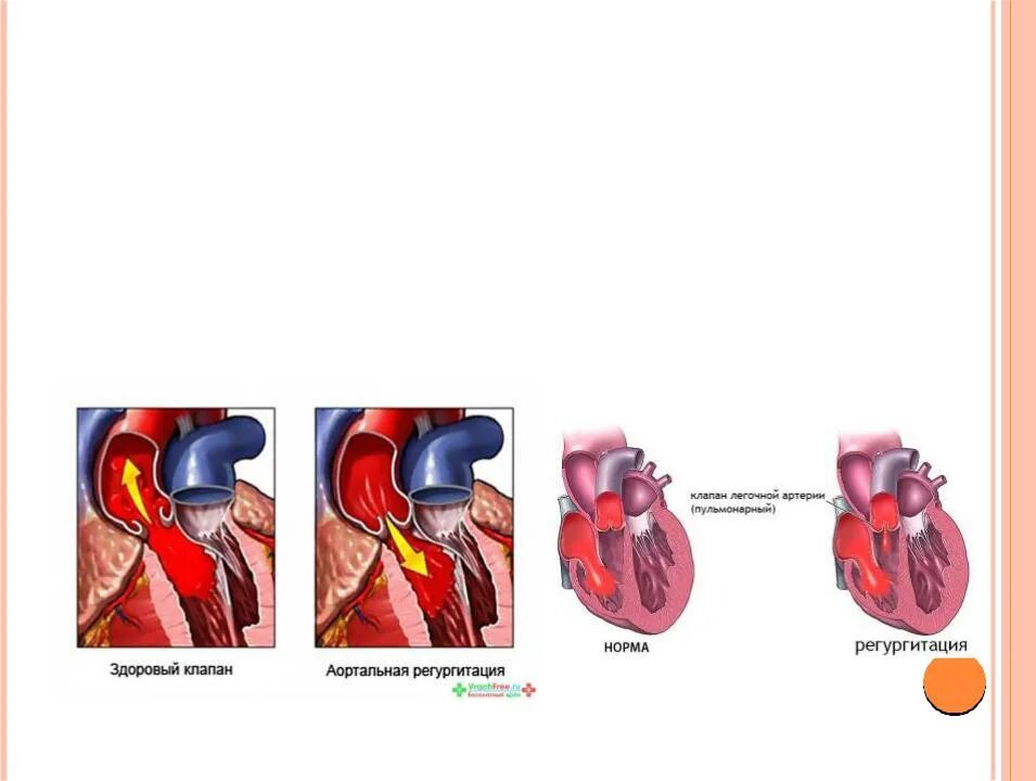 Аортальная регургитация 1 степени что это такое. Клапанная регургитация. Степени регургитации аортального клапана. Двухстворчатый аортальный клапан регургитация.