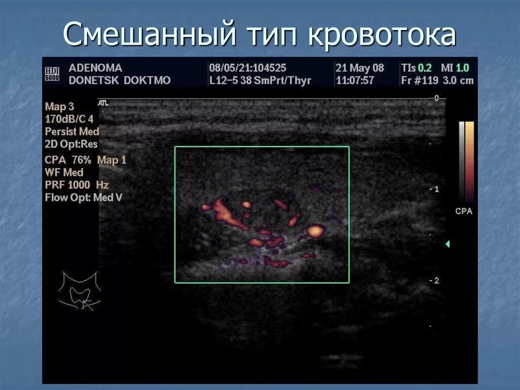 Перинодулярный кровоток что это. Перинодулярный кровоток узла щитовидной. УЗИ щитовидной железы узел смешанный кровоток. ЦДК кровоток щитовидной железы. Типы кровотока в узлах щитовидной железы.