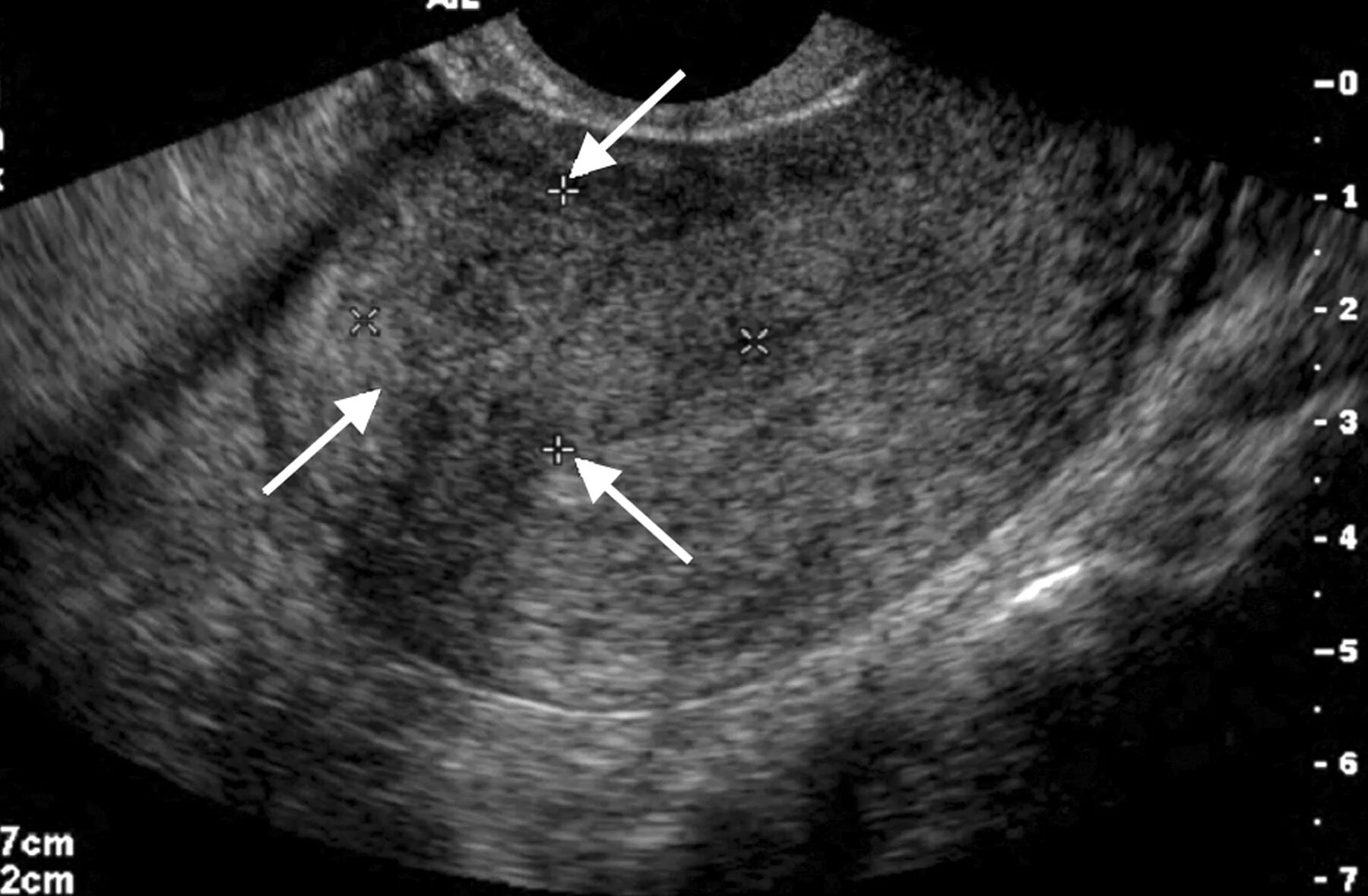 Эхопризнаки аденомиоза что это. Аденомиоз Узловая форма УЗИ. Диффузно Узловой аденомиоз УЗИ матки.