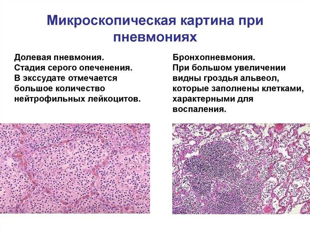 Воспаление серозной оболочки. Крупозная пневмония патанатомия макро. Очаговая абсцедирующая пневмония макропрепарат. Осаговая пгевмония микро. Абсцедирующая пневмония микропрепарат.