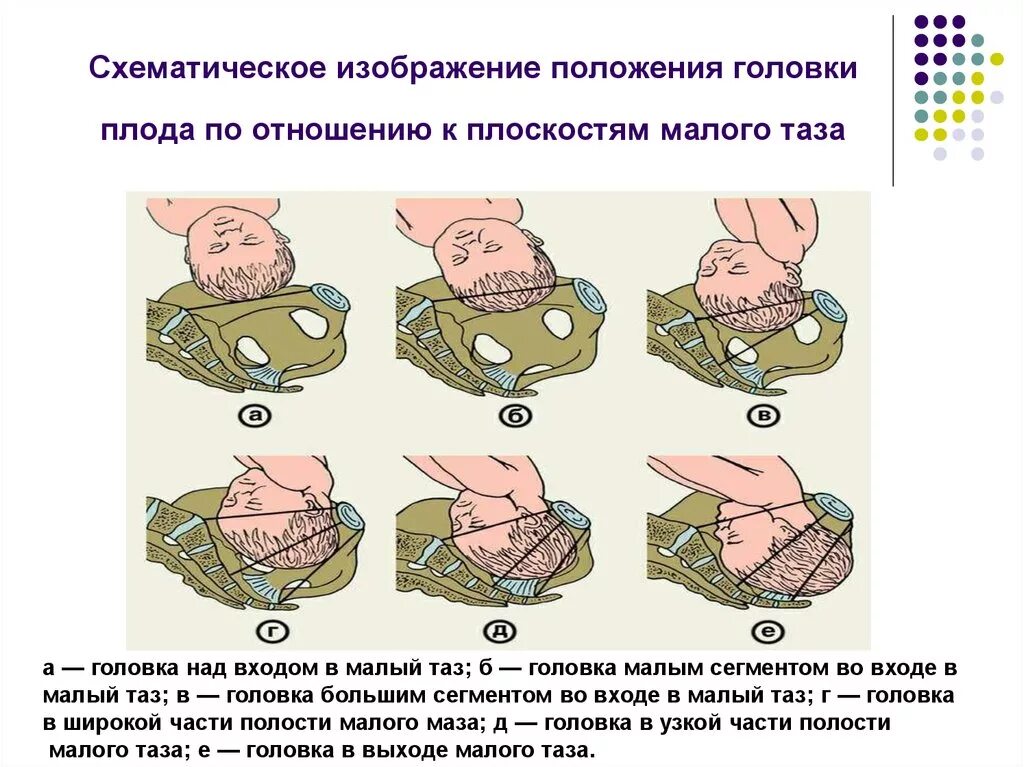 Положения головки плода. Как определяется отношение головки плода к плоскости входа малый таз. Отношение головки плода к плоскостям таза. Плоскости головки плода.