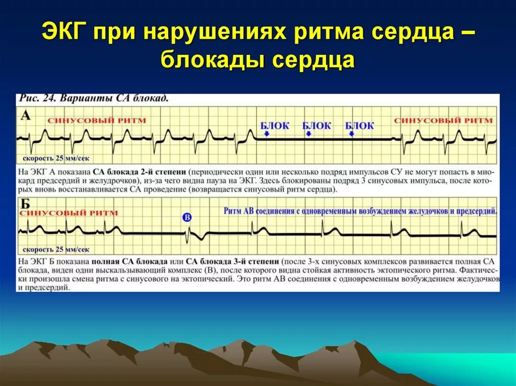 Давление блокада. Как блокада сердца на ЭКГ. Блокада сердца ритма на ЭКГ. Ритм на ЭКГ при АВ блокаде. ЭКГ при блокаде сердца 1 степени.