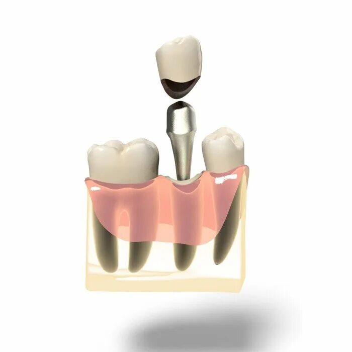 коронка логана (штифтовой зуб). фиксация коронки штифтом. Core it для фиксации стекловолоконного штифта. культевая вкладка со штифтом.