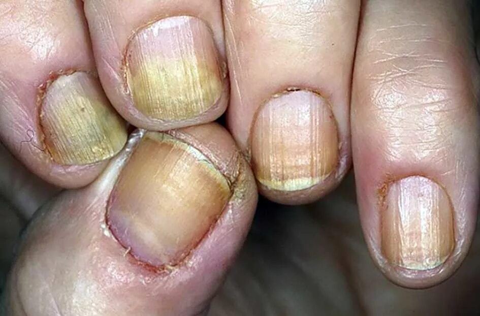Ногти стали толстыми и твердыми. Ониходистрофия - онихолизис.. Микроспория онихолизис. Грибок ногтей онихолизис.