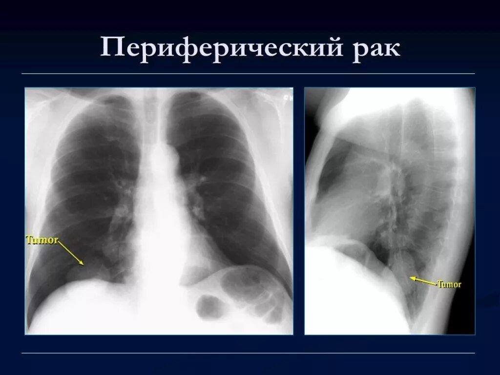 центральный тумор левого легкого. рентгенологические признаки опухоли лёгкого. рентгенологические признаки рака легкого. центральная опухоль легкого. рентгенологические признаки рака легкого.