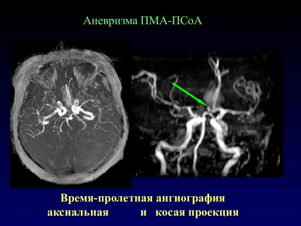 Аневризма передней мозговой артерии кт. Аксиальная ангиография. Ангиография аневризма. Сегмент а1 пма